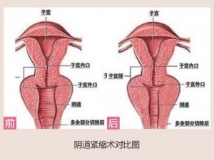 女性得阴挺病是怎么回事？私密处松弛？妇科炎症？私密整形让你重拾自信